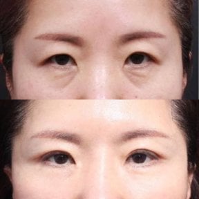 نتائج شد الجفون قبل وبعد في Returning Plastic Surgery، تحسين تصحيح الجفون