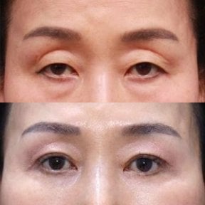Before and after blepharoplasty results at Returning Plastic Surgery, eyelid correction outcome