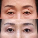 Before and after blepharoplasty results at Returning Plastic Surgery, eyelid correction outcome