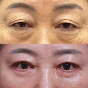 Before and after blepharoplasty results at Returning Plastic Surgery, eyelid correction improvement