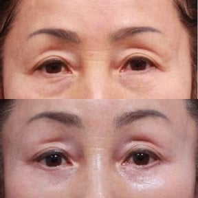 Before and after blepharoplasty results at Returning Plastic Surgery, eyelid correction improvement