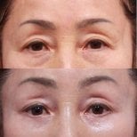 Before and after blepharoplasty results at Returning Plastic Surgery, eyelid correction improvement
