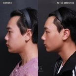 Before and after rhinoplasty result at VG Plastic Surgery, improved nose profile after 2 months