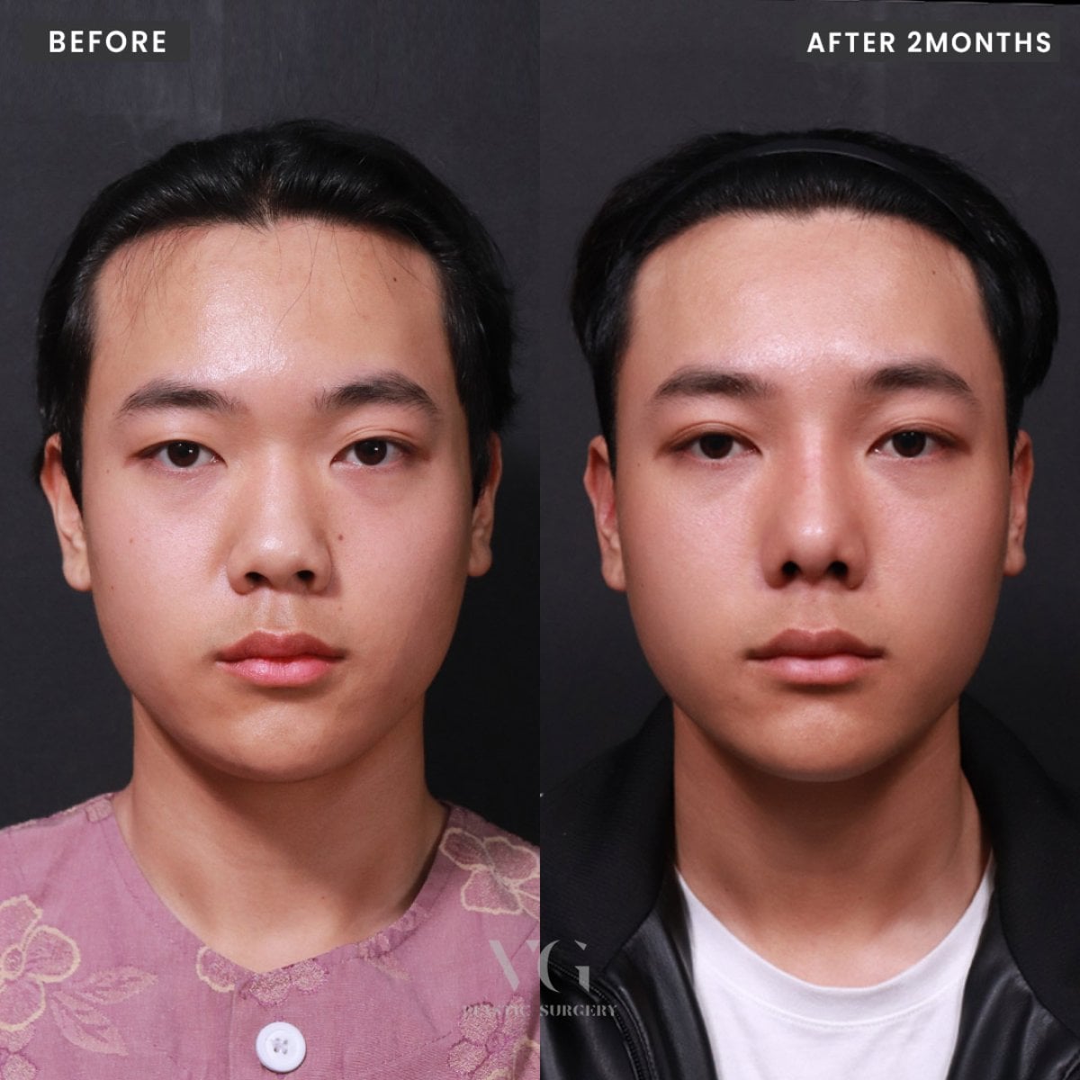 نتائج تجميل الأنف قبل وبعد في VG Plastic Surgery، إعادة تشكيل الأنف بعد شهرين