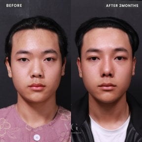 Before and after rhinoplasty results at VG Plastic Surgery, nose reshaping after 2 months