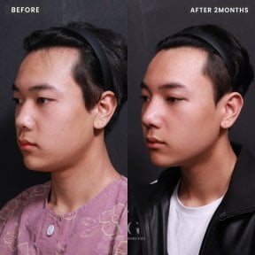 Результат ринопластики до и после в VG Plastic Surgery, улучшенная форма носа через 2 месяца