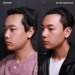 Результат ринопластики до и после в VG Plastic Surgery, улучшенная форма носа через 2 месяца