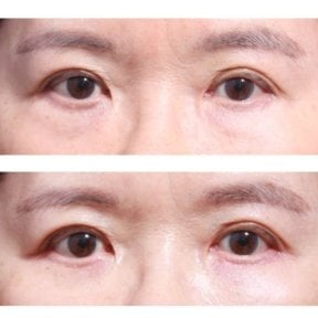 Before and after blepharoplasty results at Returning Plastic Surgery, eyelid correction improvement