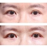 Before and after blepharoplasty results at Returning Plastic Surgery, eyelid correction improvement