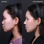 Resultados de rinoplastia antes y después en VG Plastic Surgery, perfil nasal mejorado tras 2 meses