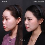 Before and after rhinoplasty results at VG Plastic Surgery, nose reshaping after 2 months