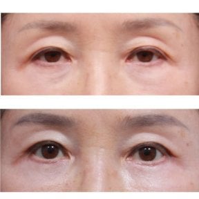 نتائج شد الجفون قبل وبعد في Returning Plastic Surgery، تحسين تصحيح الجفن