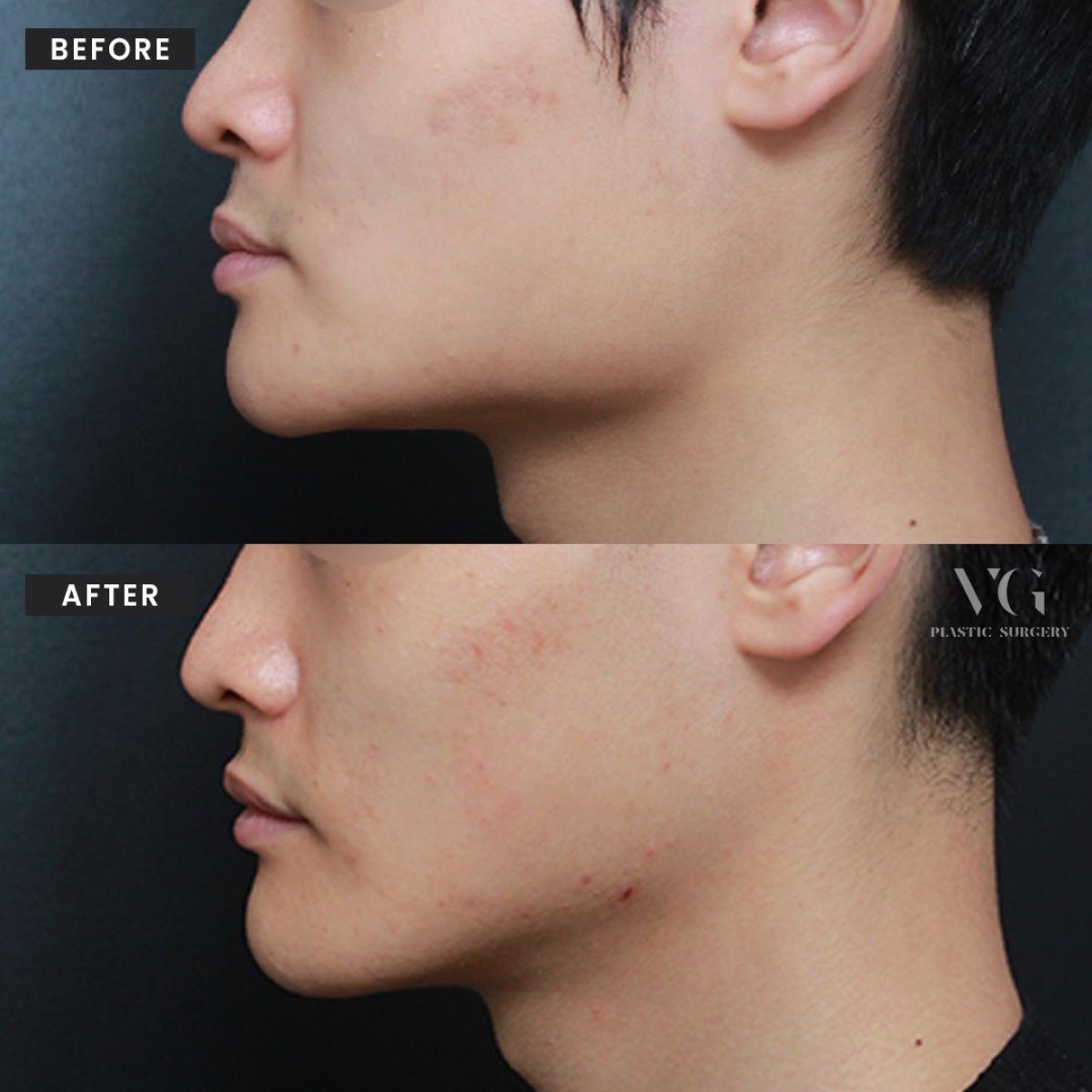 Antes y después de contorno facial en VG Plastic Surgery, mejora de mentón y mandíbula