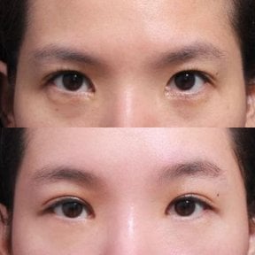 Результаты блефаропластики до и после в Returning Plastic Surgery, коррекция век