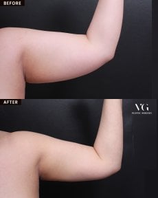 Результаты липосакции рук до и после в VG Plastic Surgery, видимое улучшение контура
