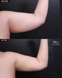Результаты липосакции рук до и после в VG Plastic Surgery, видимое улучшение контура