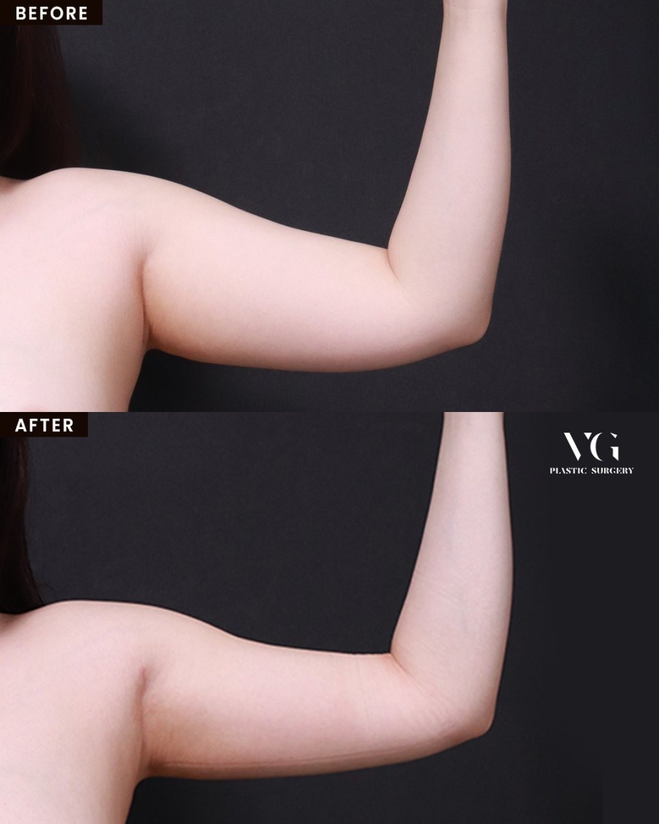 Résultats avant et après liposuccion des bras chez VG Plastic Surgery, contour amélioré