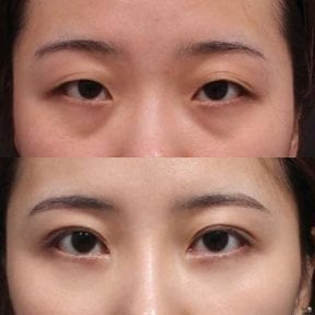 Блефаропластика до и после в Returning Plastic Surgery, улучшение коррекции век