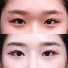 Результаты блефаропластики до и после в Returning Plastic Surgery, коррекция век