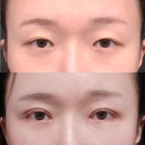 Результаты блефаропластики до и после в Returning Plastic Surgery, коррекция век