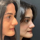 Resultados de rinoplastia antes y después en Op. Dr. Sinan Eroglu Clinic, remodelación nasal