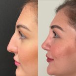 نتائج عملية تجميل الأنف قبل وبعد في عيادة Op. Dr. Sinan Eroglu، إعادة تشكيل الأنف