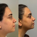 Before and after revision rhinoplasty results at Op. Dr. Sinan Eroglu Clinic, nose reshaping