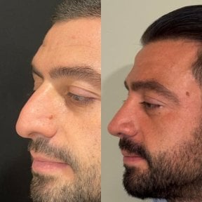 Before and after rhinoplasty results at Op. Dr. Sinan Eroglu Clinic, improved nose profile
