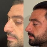 Before and after rhinoplasty results at Op. Dr. Sinan Eroglu Clinic, improved nose profile