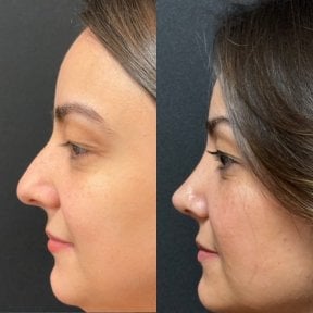 Before and after rhinoplasty results at Op. Dr. Sinan Eroglu Clinic, improved nose profile