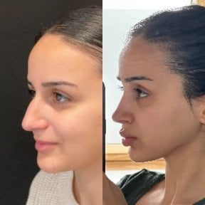 Before and after rhinoplasty results at Op. Dr. Sinan Eroglu Clinic, nose reshaping outcome
