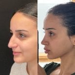 Before and after rhinoplasty results at Op. Dr. Sinan Eroglu Clinic, nose reshaping outcome
