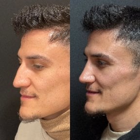Before and after rhinoplasty results at Op. Dr. Sinan Eroglu Clinic, improved nose profile