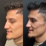 Before and after rhinoplasty results at Op. Dr. Sinan Eroglu Clinic, improved nose profile