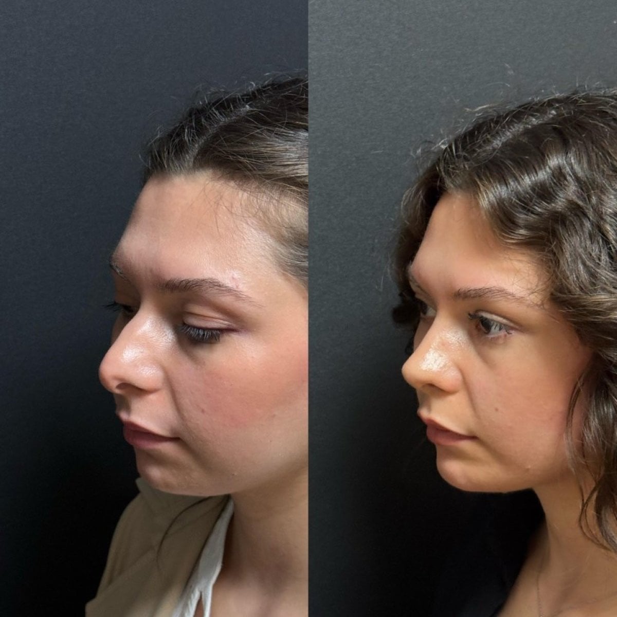 نتيجة قبل وبعد عملية تجميل الأنف التصحيحية في عيادة Op. Dr. Sinan Eroglu، إعادة تشكيل الأنف
