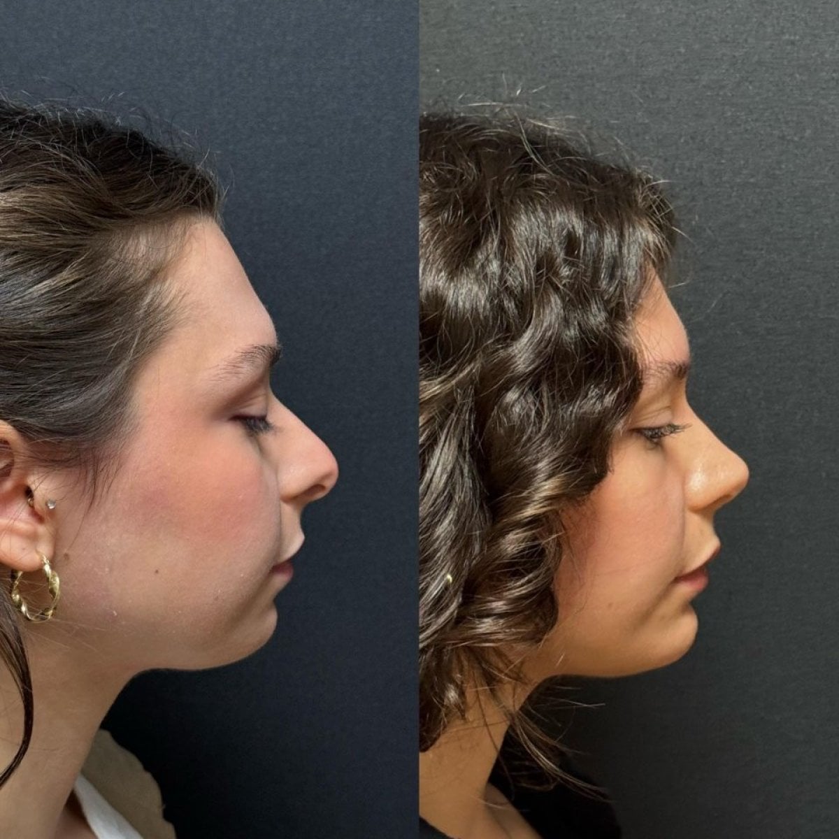 نتائج قبل وبعد تجميل الأنف التصحيحي في عيادة Op. Dr. Sinan Eroglu، إعادة تشكيل الأنف