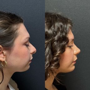 Результаты до и после риносептопластики в клинике Op. Dr. Sinan Eroglu, коррекция носа