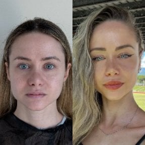 Before and after chin implant results at Op. Dr. Sinan Eroglu Clinic, enhanced jawline contour