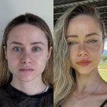 Before and after chin implant results at Op. Dr. Sinan Eroglu Clinic, enhanced jawline contour