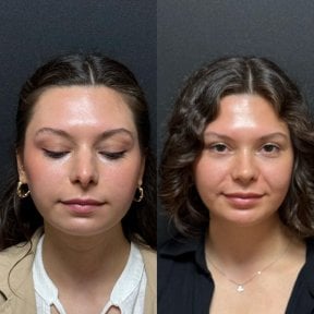 Before and after septoplasty results at Op. Dr. Sinan Eroglu Clinic for deviated septum correction