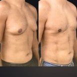 Résultats avant/après liposuccion 360 à Memorial Bahçelievler Hospital, remodelage masculin
