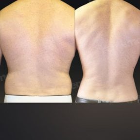 360 liposuction before and after results at Memorial Bahçelievler Hospital, slimmer back contour