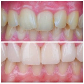 Vorher-nachher-Ergebnis Zahnkronen bei Omara Dental Centers, verbesserte Zahnästhetik