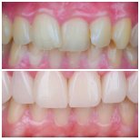 Vorher-nachher-Ergebnis Zahnkronen bei Omara Dental Centers, verbesserte Zahnästhetik