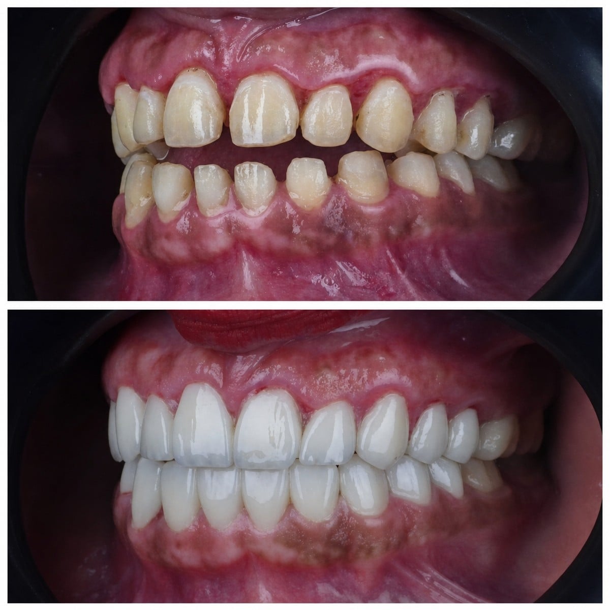 Resultados antes y después de coronas dentales en Omara Dental Centers, sonrisa mejorada