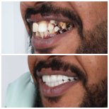 Vorher-nachher-Ergebnis Zahnkronen bei Omara Dental Centers, Lächeln-Transformation