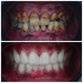 Resultados antes y después de coronas de zirconia en Omara Dental Centers, restauración de sonrisa