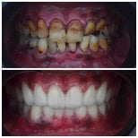 Resultados antes y después de coronas de zirconia en Omara Dental Centers, restauración de sonrisa