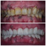 Hollywood Smile Vorher-Nachher-Ergebnisse bei Omara Dental Centers – komplette Zahnsanierung