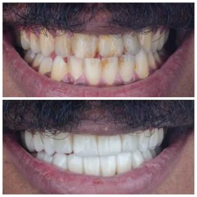 Hollywood Smile Vorher-Nachher-Ergebnis bei Omara Dental Centers – weiße, gerade Zähne